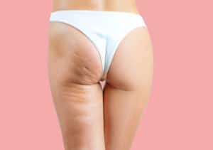 Cellulite bei Frauenbeinen
