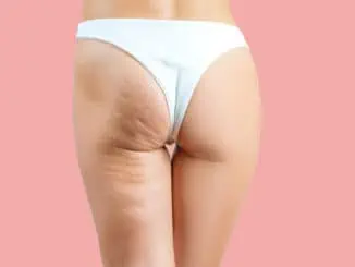 Cellulite bei Frauenbeinen